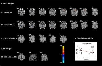 Altered Amplitude of Low-Frequency Fluctuations and Functional Connectivity in Excessive Daytime Sleepiness in Parkinson Disease